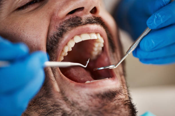 Best Broken or Chipped Tooth Repair in Wills Point, TX